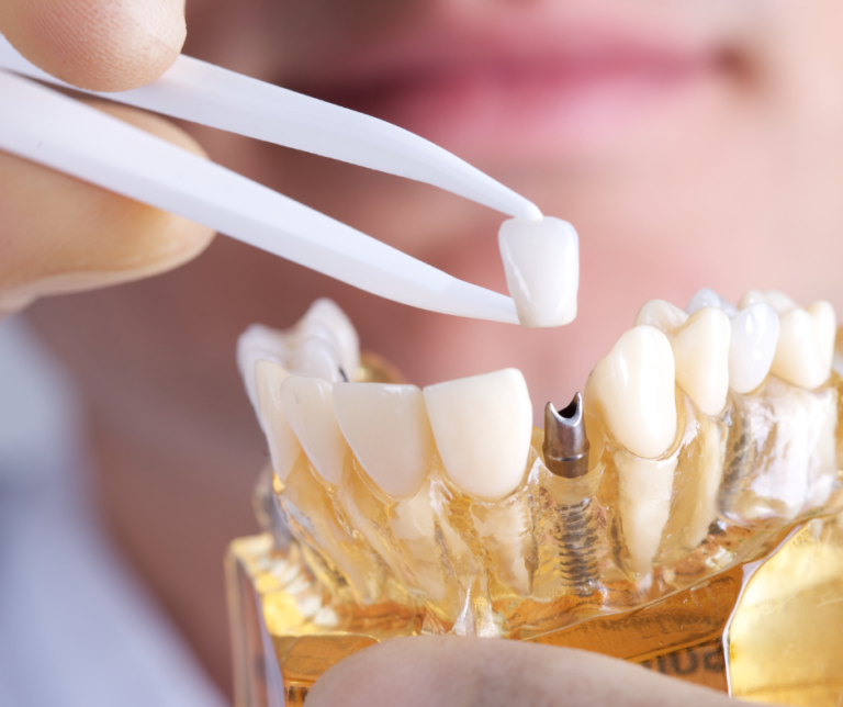 Modèle d'implant dentaire et couronne céramique