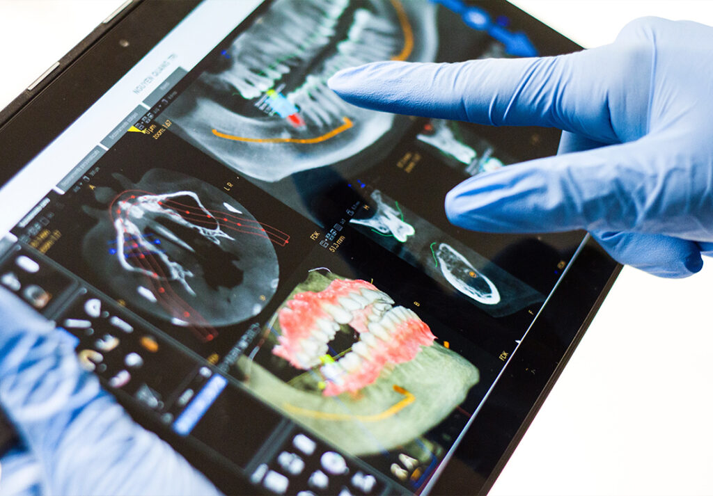 Planification d'un implant dentaire sur imagerie 3D